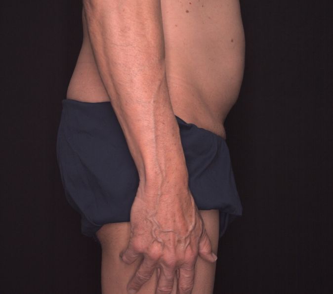 Sofwave Before & After