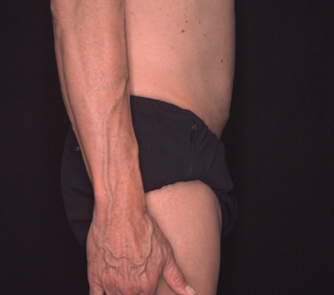 Sofwave Before & After