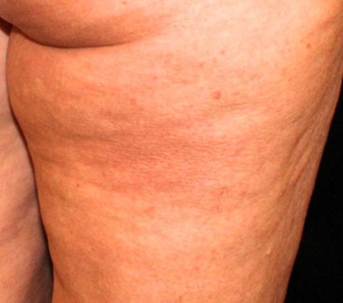 Sofwave Before & After