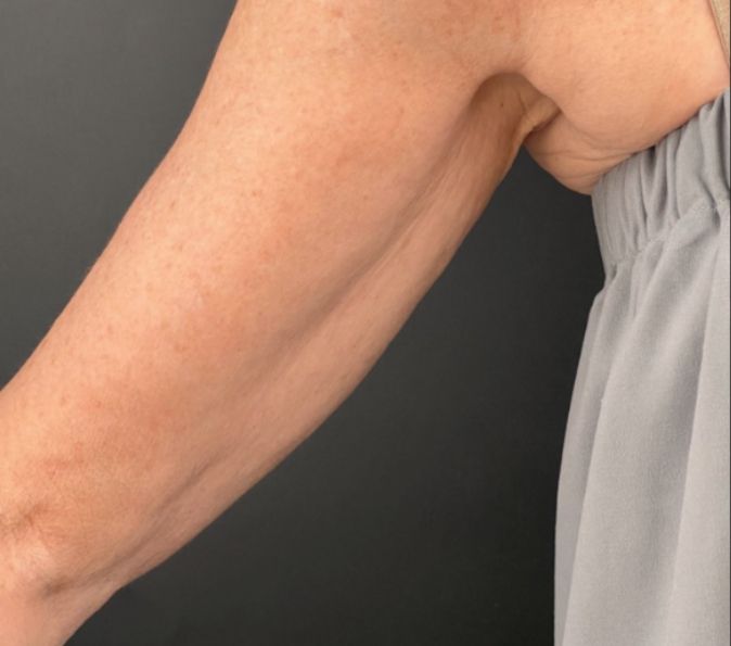 Sofwave Before & After