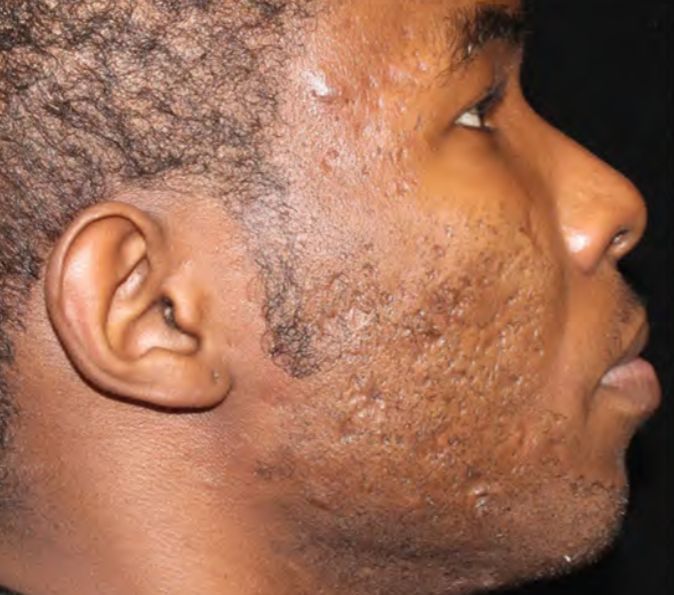 Sofwave Before & After