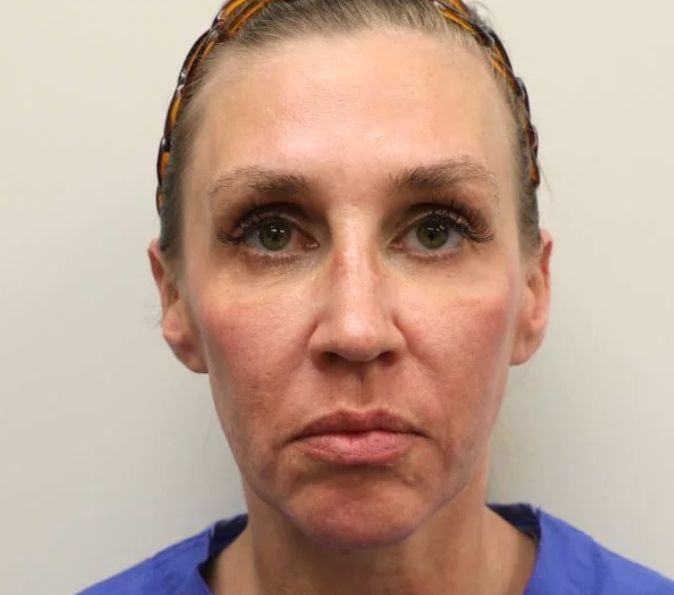 Sofwave Before & After