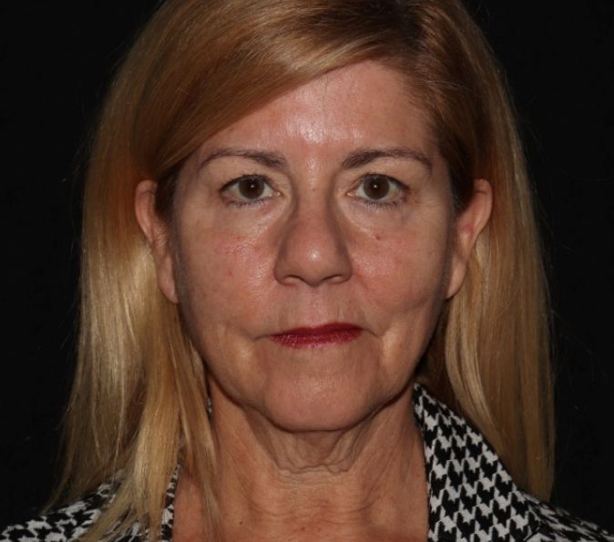 Sofwave Before & After