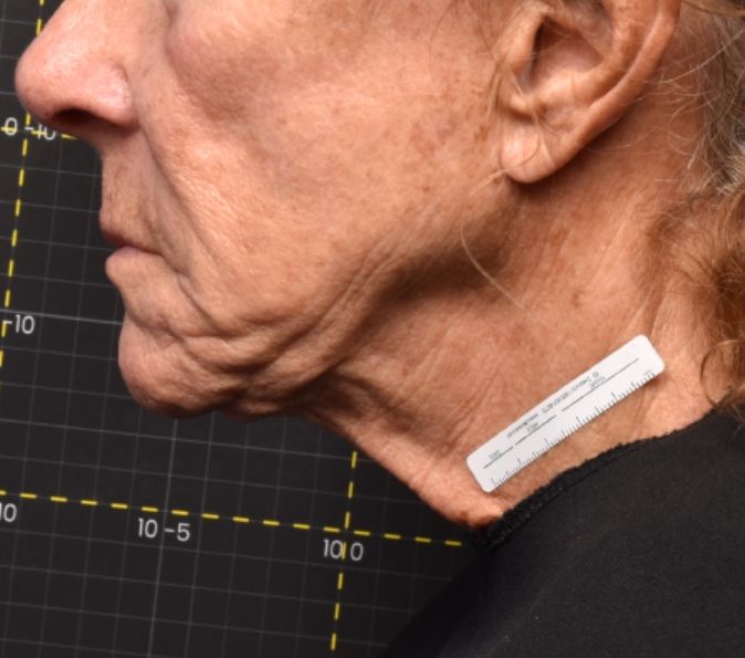 Sofwave Before & After