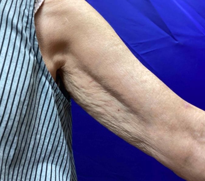 Sofwave Before & After