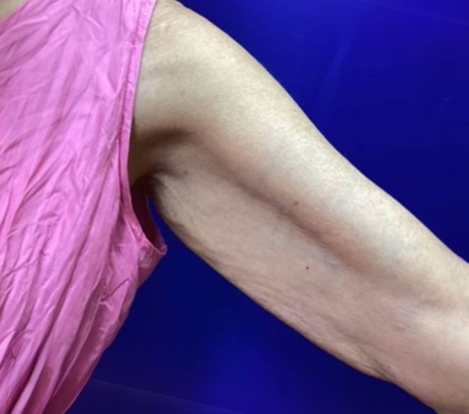 Sofwave Before & After